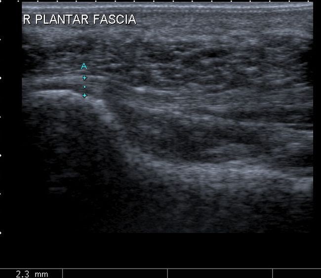 Platelet Rich Plasma Therapy Dry Needling effective for Platelet Rich Plasma Therapy Dry Needling effective for