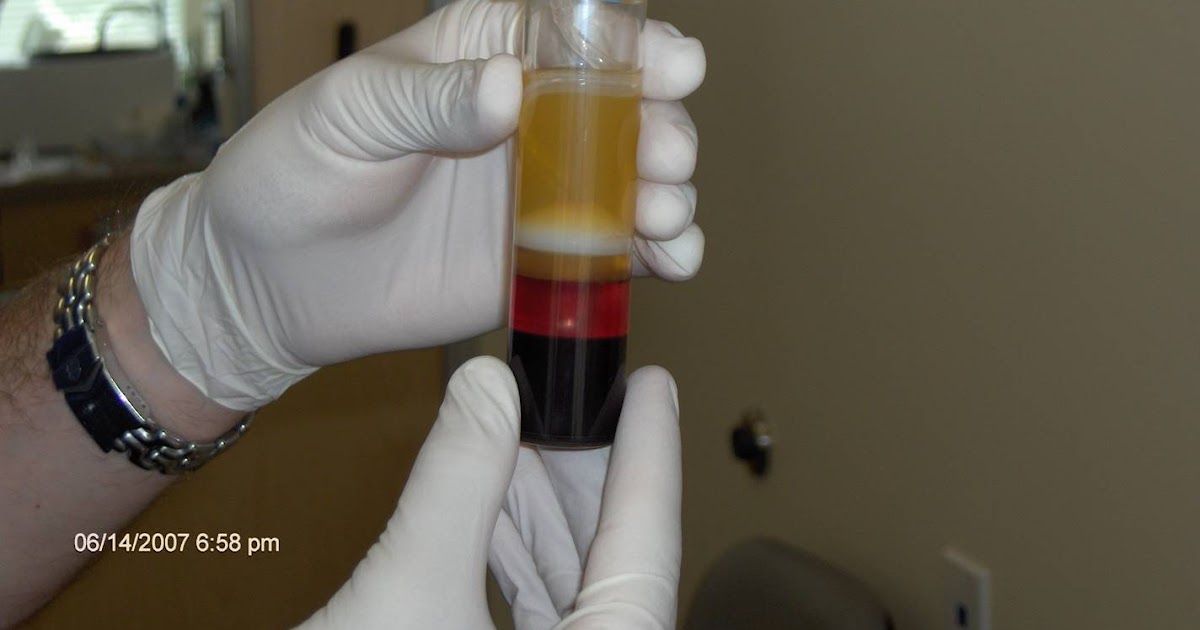 Platelet Rich Plasma Therapy Dr Steven Sampson selected