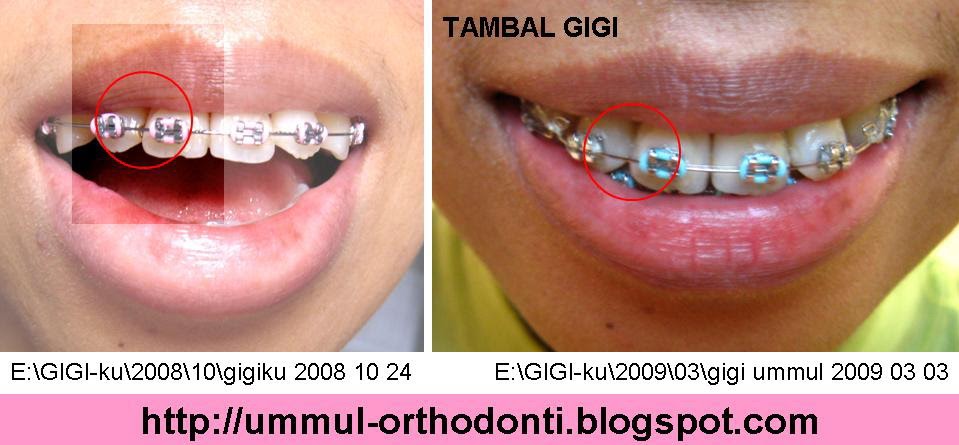 O R T H O D O N T I Gigi Seri Atas Kanan Right Upper Lateral Incisor