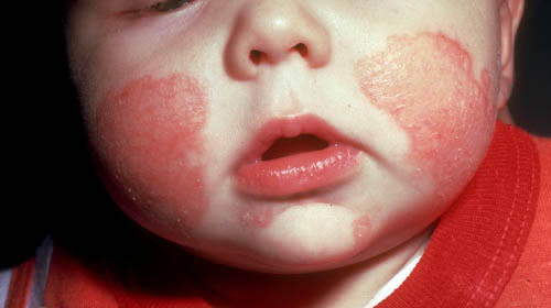 Baby Egg Allergy Rash Pictures