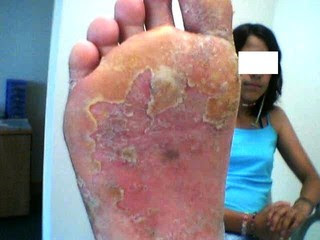 Que unguentos tratar um fungo em um corpo