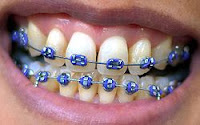 Lihat di Wikipedia tentang braces alias behel