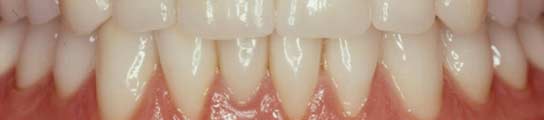 [resisten+dientes.jpg]