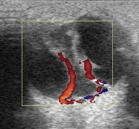 The Suprachoroidal Space Is Normally Virtual Because Choroid In Close Apposition To Sclera As Fluid Accumulates This Becomes Real The Suprachoroidal Space Is Normally Virtual Because Choroid In Close Apposition To Sclera As Fluid Accumulates This Becomes Real