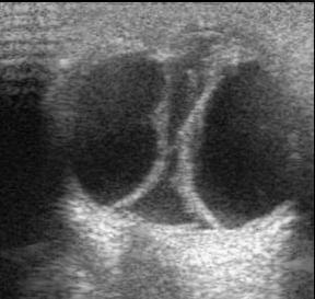 Choroidal Detachment USG Choroidal Detachment USG