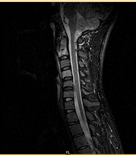 Spinal Tb Mri