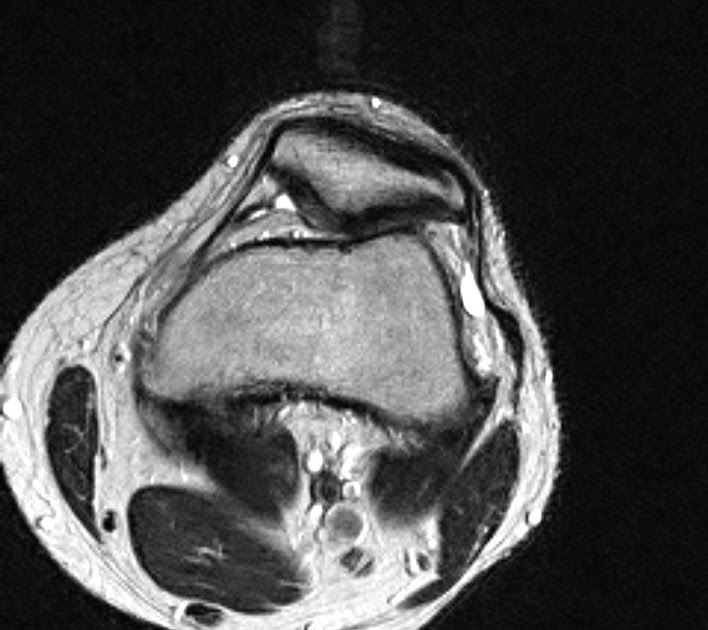 Lateral Patellar Tilt Sumer's Radiology Blog