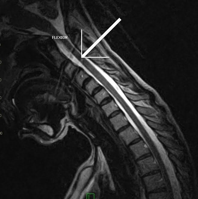 Flexion & Extension Cervical MRI Sumer's Radiology Blog