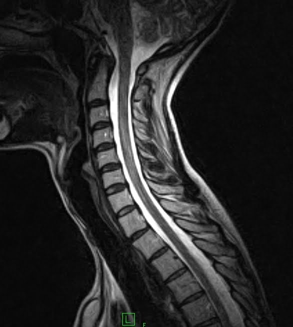 Flexion & Extension Cervical MRI Sumer's Radiology Blog
