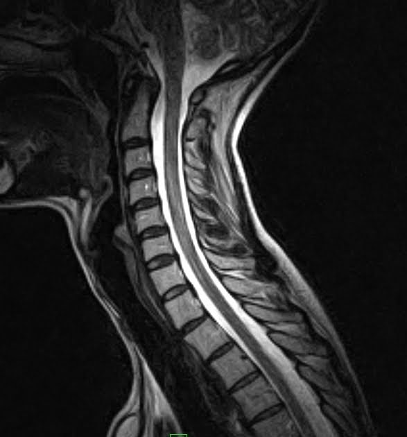 Flexion & Extension Cervical MRI Sumer's Radiology Blog