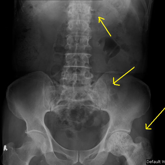Paget's Disease of Bone - Sumer's Radiology Blog