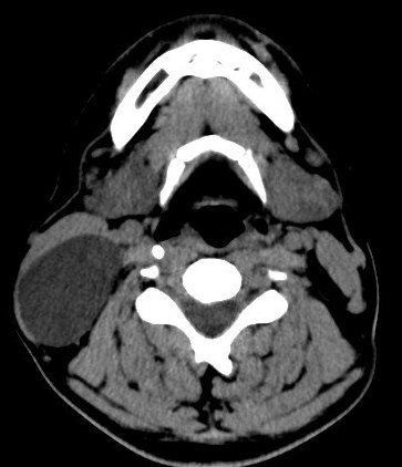 Branchial Cleft Cyst