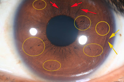 Iridology Stress Rings