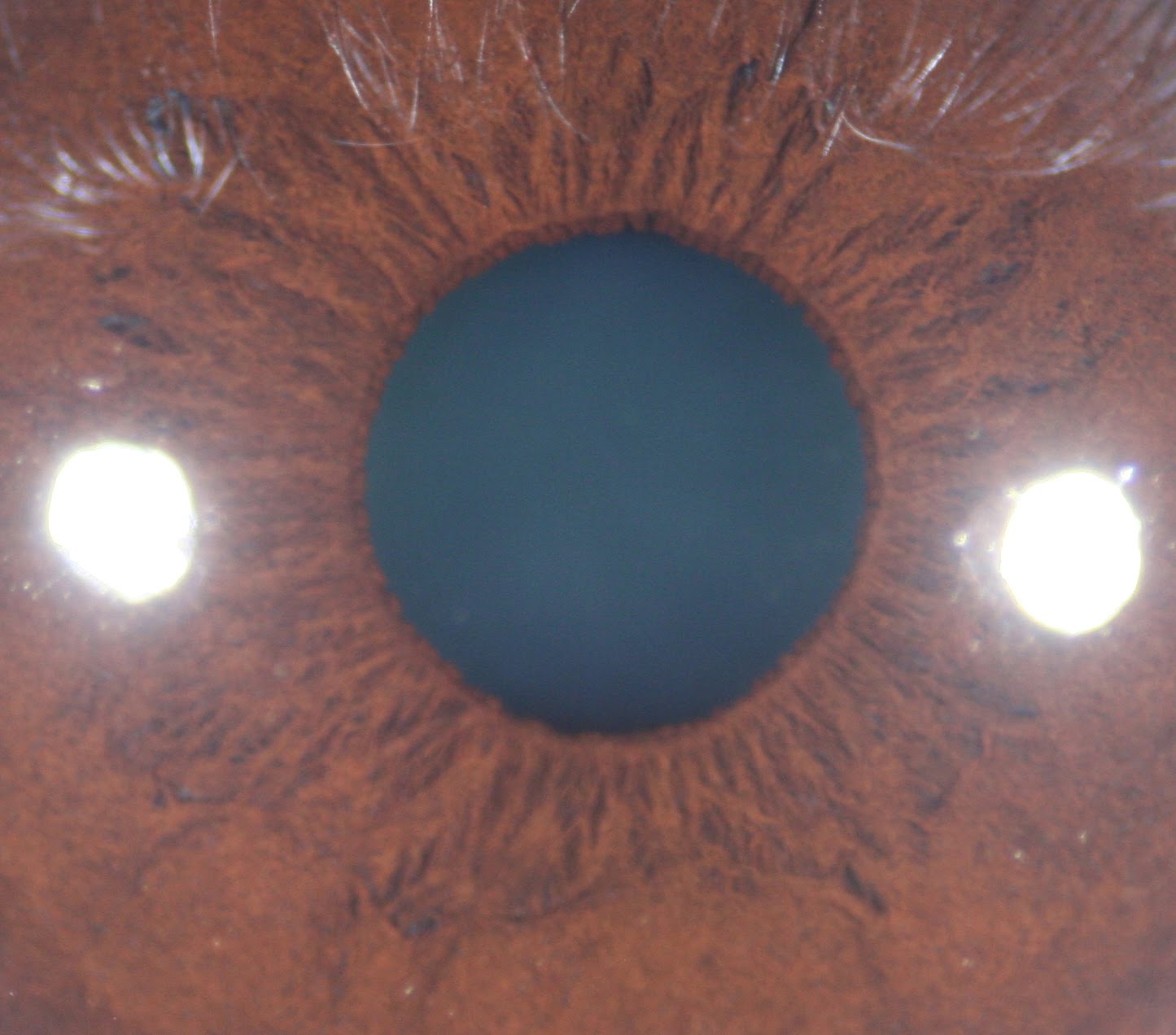 Iridology Stress Rings