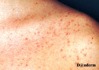 Post steroid acne treatment