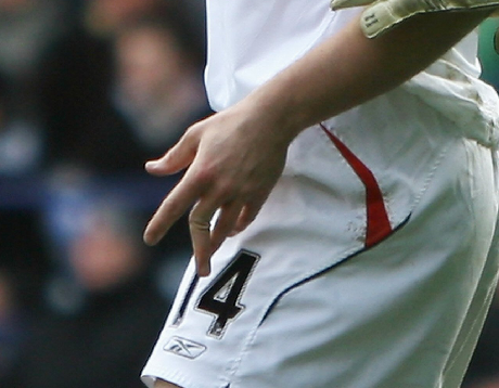 kevin-davies-dislocated-finger.png
