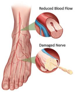 Diabetes type 2 symptoms leg pain naan