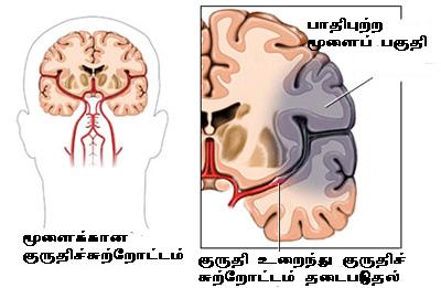 [BLOOD-CLOT-BRAIN-400.JPG]