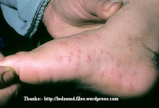கை கால் வாய்ப்புண் நோய் (Hand Foot and Mouth Disease) Hand+foot+mouth+disease+3