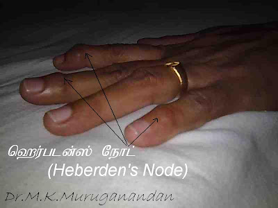 மூட்டுத் தேய்வு நோயை இனங் காட்டும் ஹெர்படன்ஸ் நோட் (Heberden's Node) Herbedes+node