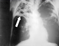 Tuberculose pulmonar
