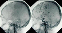 Transplante morte cerebral