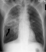 Radiografia de tórax com pneumonia