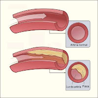 placas de colesterol nos vasos