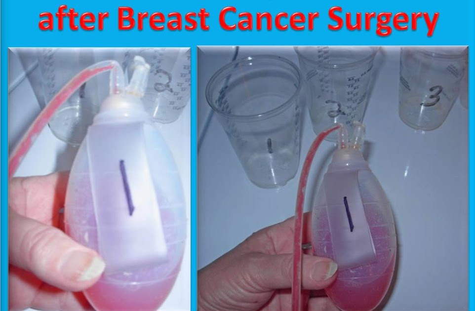Ask DJ Lyons Video Tutorial How to empty Mastectomy Drain Bottles