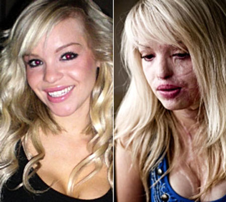 Katie Piper before and after Photos - Tickle Thy Thoughts