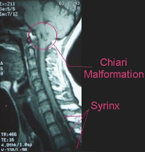 Chiari/Syrinx