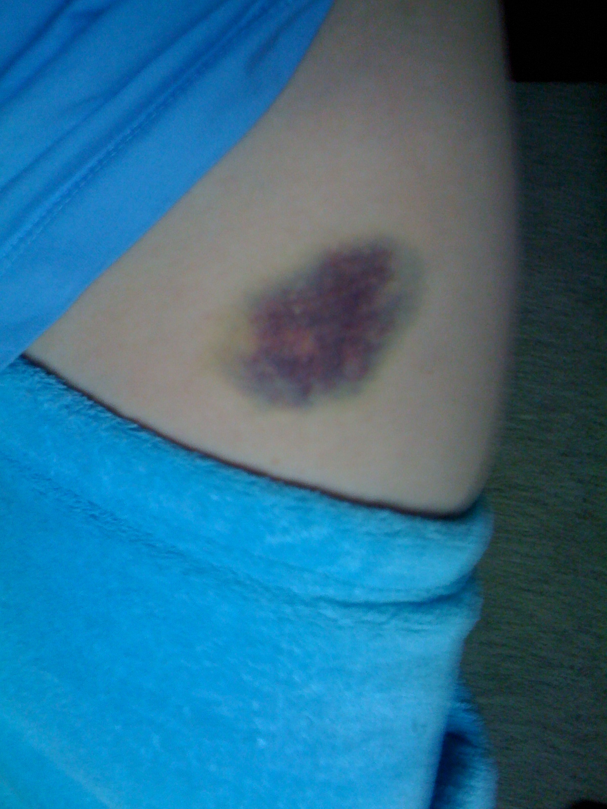From This Point. Forward. Enbrel Bruise