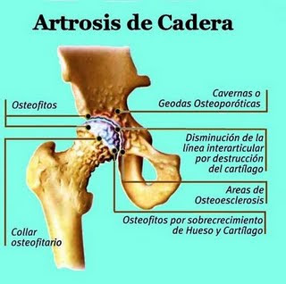 De Artrosis De Cadera En Venta ~ Como Se Puede Curar La Artritis De ...