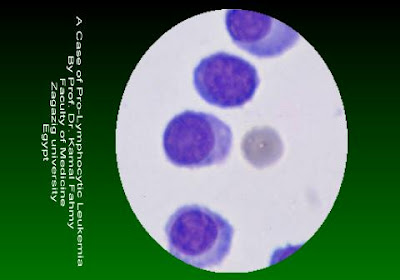 اطلس علم الدم -1- ProLymphocytic+Leukemia