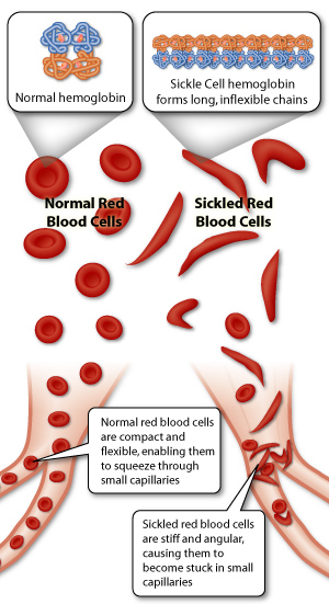 sickle cell diagram health tips elephantiasis lymphatic filariasis crabs sickle cell diagram health tips elephantiasis lymphatic filariasis crabs