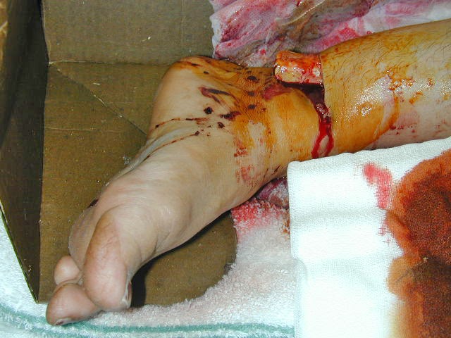 Bailee's Anatomy Blog: Bones: Fracture Types November 1, 2010