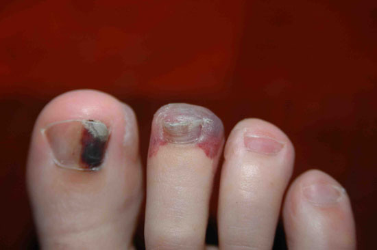 Fl podiatrist discusses runner's toenails Runners Toes - Holistic Athlete