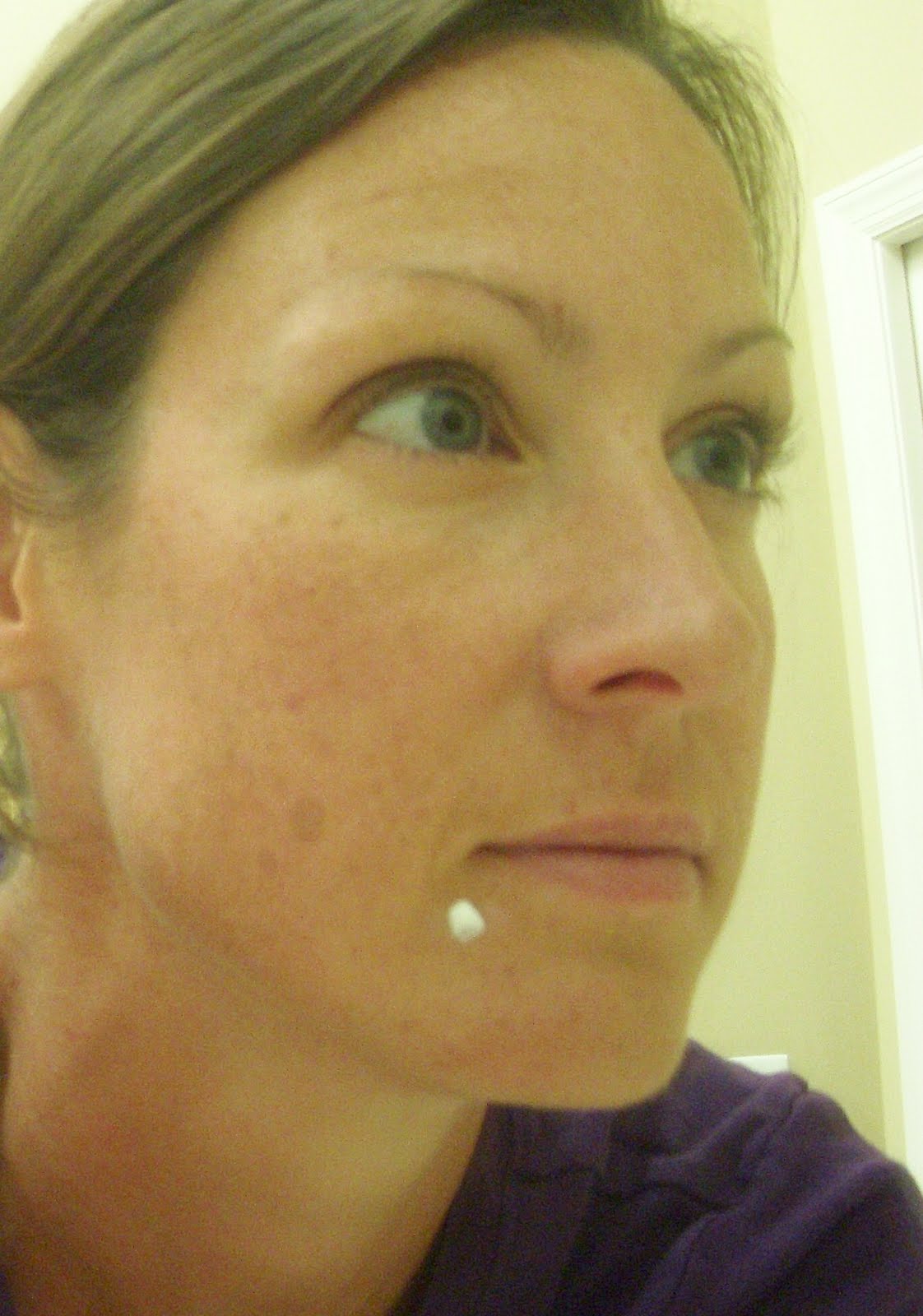 Hope Studios Why Don't You...Zap That Zit!