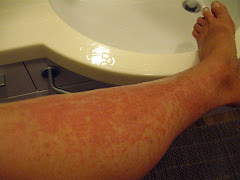 KJ's red rash from the Cemetary ??