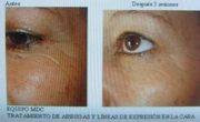 antes y despues