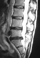 Lumbar MRI of Severe L5/S1 Disc Herniation