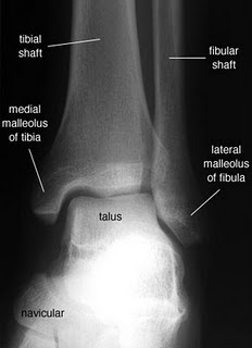 Radiologia e Imaginologia - O Paradigma da imagem ... broken knee bones diagram 