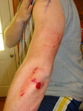 Arm Road Rash - post-AtomicMan