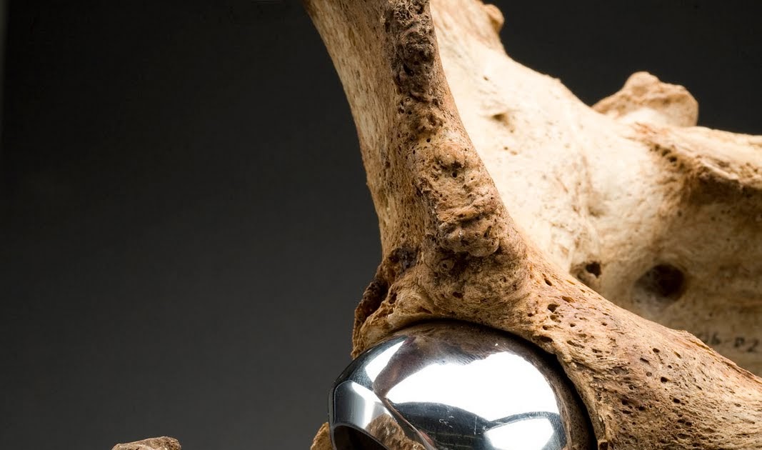 Plastic & orthopedic surgery Can I Be Allergic to a Metal Implant?