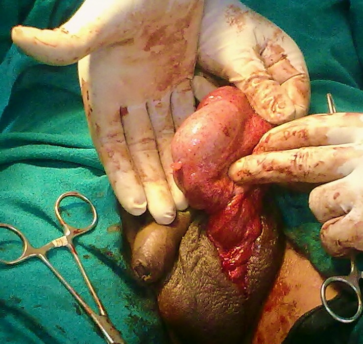Appendix Testis