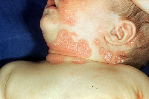 La psoriasis como humedecer el cuero cabelludo