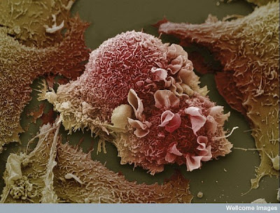 15 imágenes microscópicas del cuerpo humano. 10.+Lung+cancer+cells.