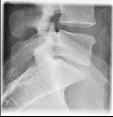 retrolisthesis due to accident Free, official coding info for 2018 icd-10-cm m4316 - includes detailed rules, notes, synonyms, icd-9-cm conversion, index and annotation crosswalks, drg grouping and more. retrolisthesis due to accident Free, official coding info for 2018 icd-10-cm m4316 - includes detailed rules, notes, synonyms, icd-9-cm conversion, index and annotation crosswalks, drg grouping and more.