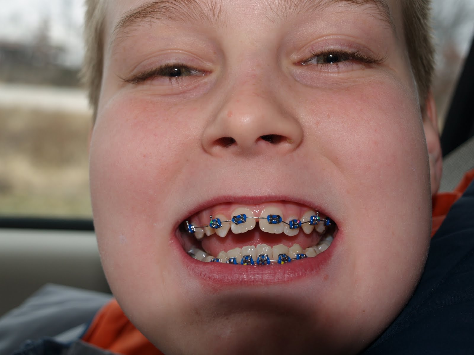 It�s A Schmoll World Look Who got Braces&hellip;