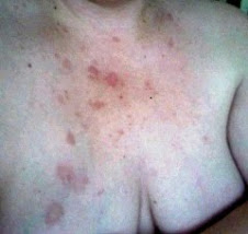 Chest Rash